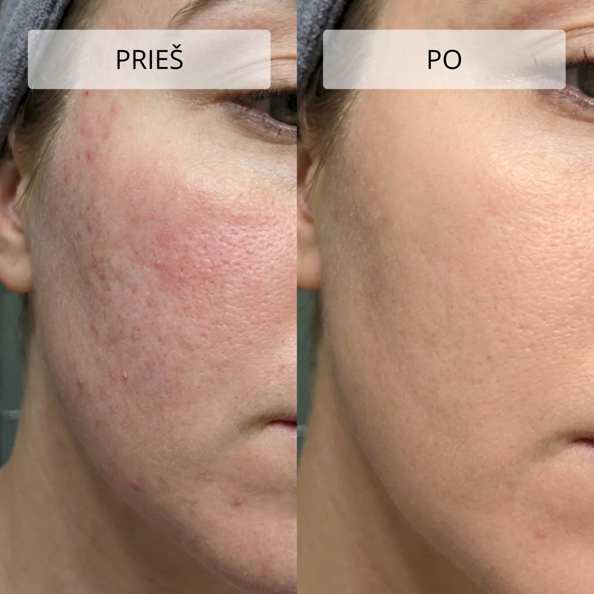 Stangrinamasis masažuoklis veidui ir kaklui DERM LiftPro - Image 15