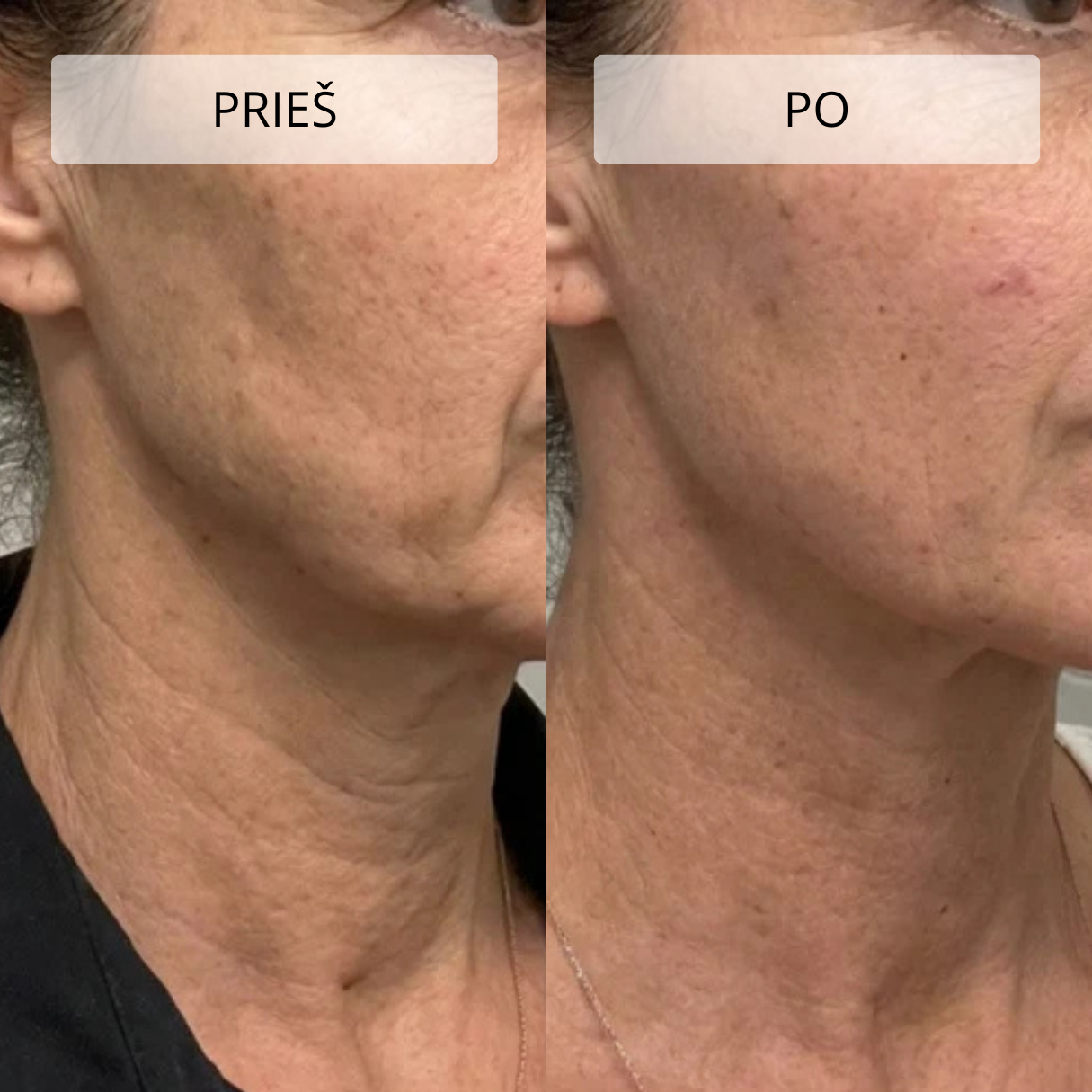 Stangrinamasis masažuoklis veidui ir kaklui DERM LiftPro - Image 10