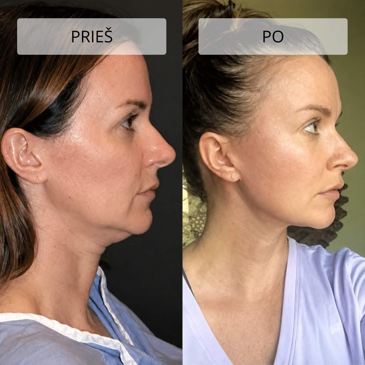 Stangrinamasis masažuoklis veidui ir kaklui DERM LiftPro - Image 11