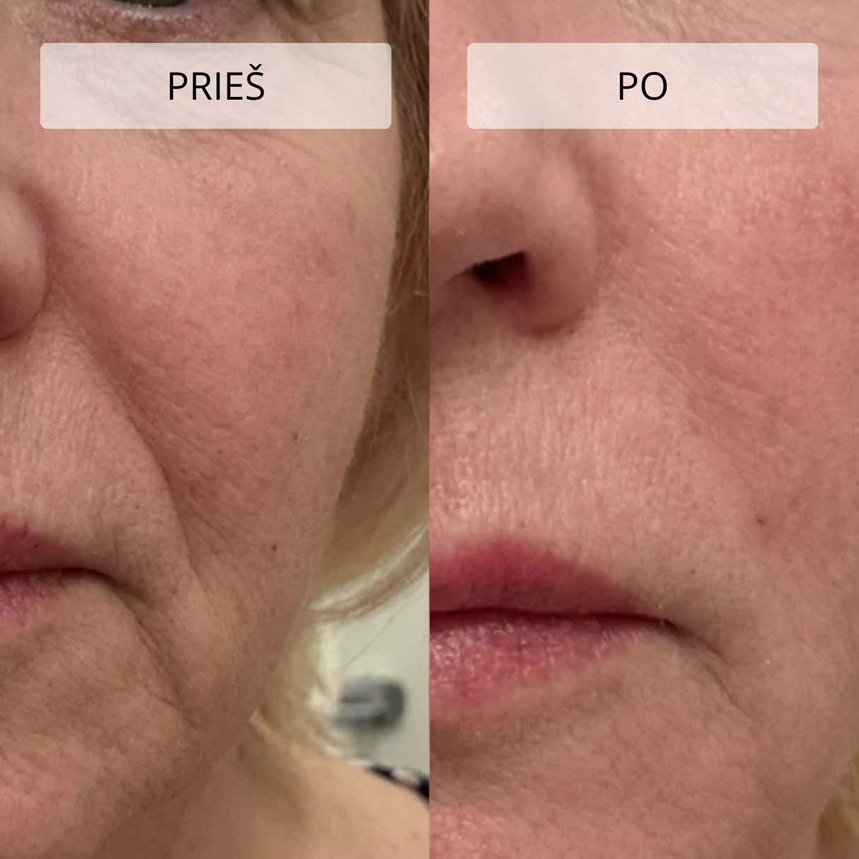 Stangrinamasis masažuoklis veidui ir kaklui DERM LiftPro - Image 12