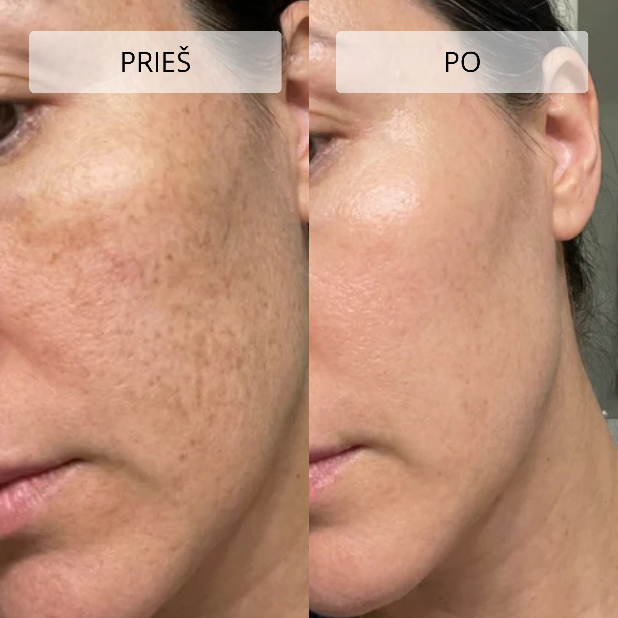 Stangrinamasis masažuoklis veidui ir kaklui DERM LiftPro - Image 13