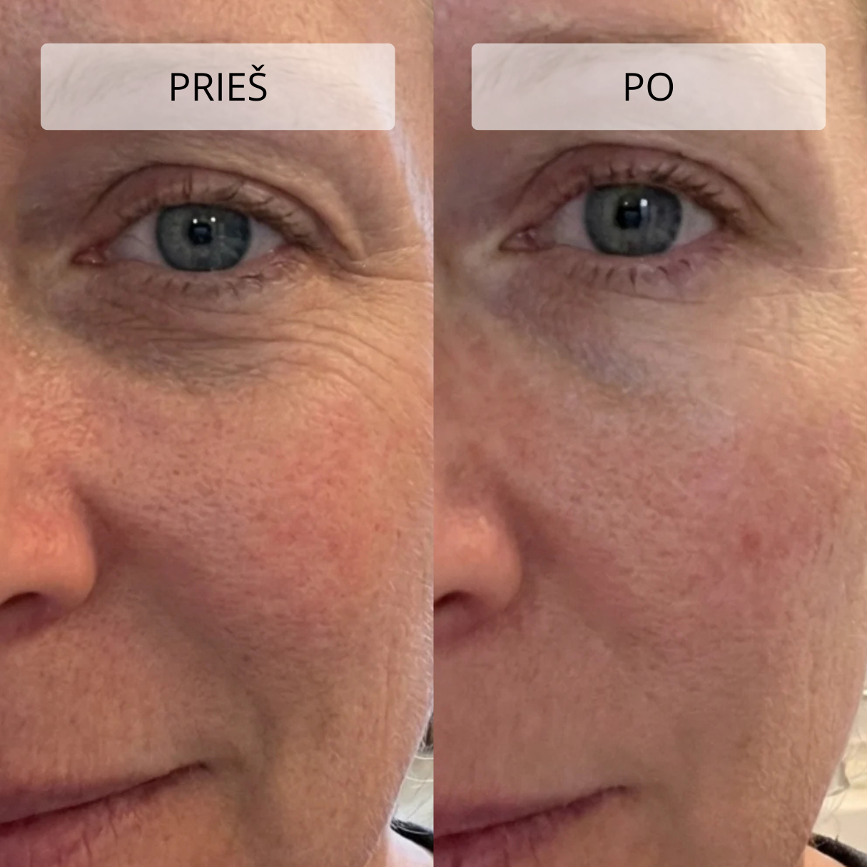Stangrinamasis masažuoklis veidui ir kaklui DERM LiftPro - Image 14